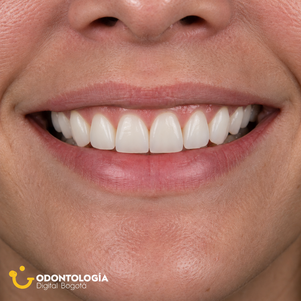 Después del tratamiento de diseño de sonrisa