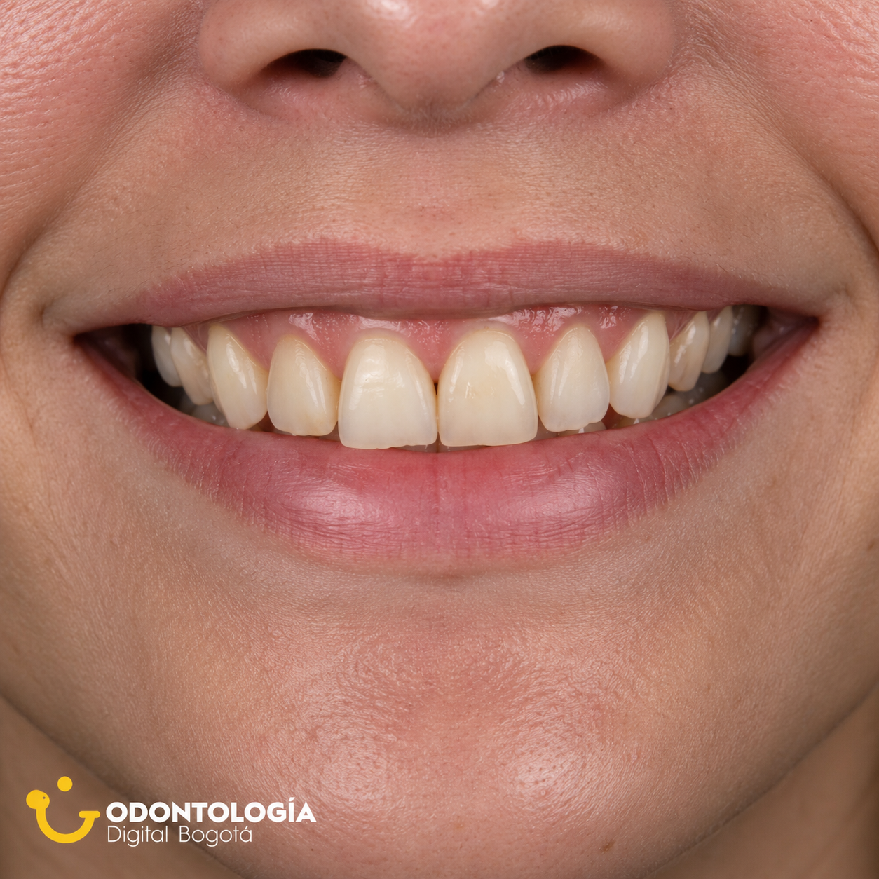Antes del tratamiento de diseño de sonrisa