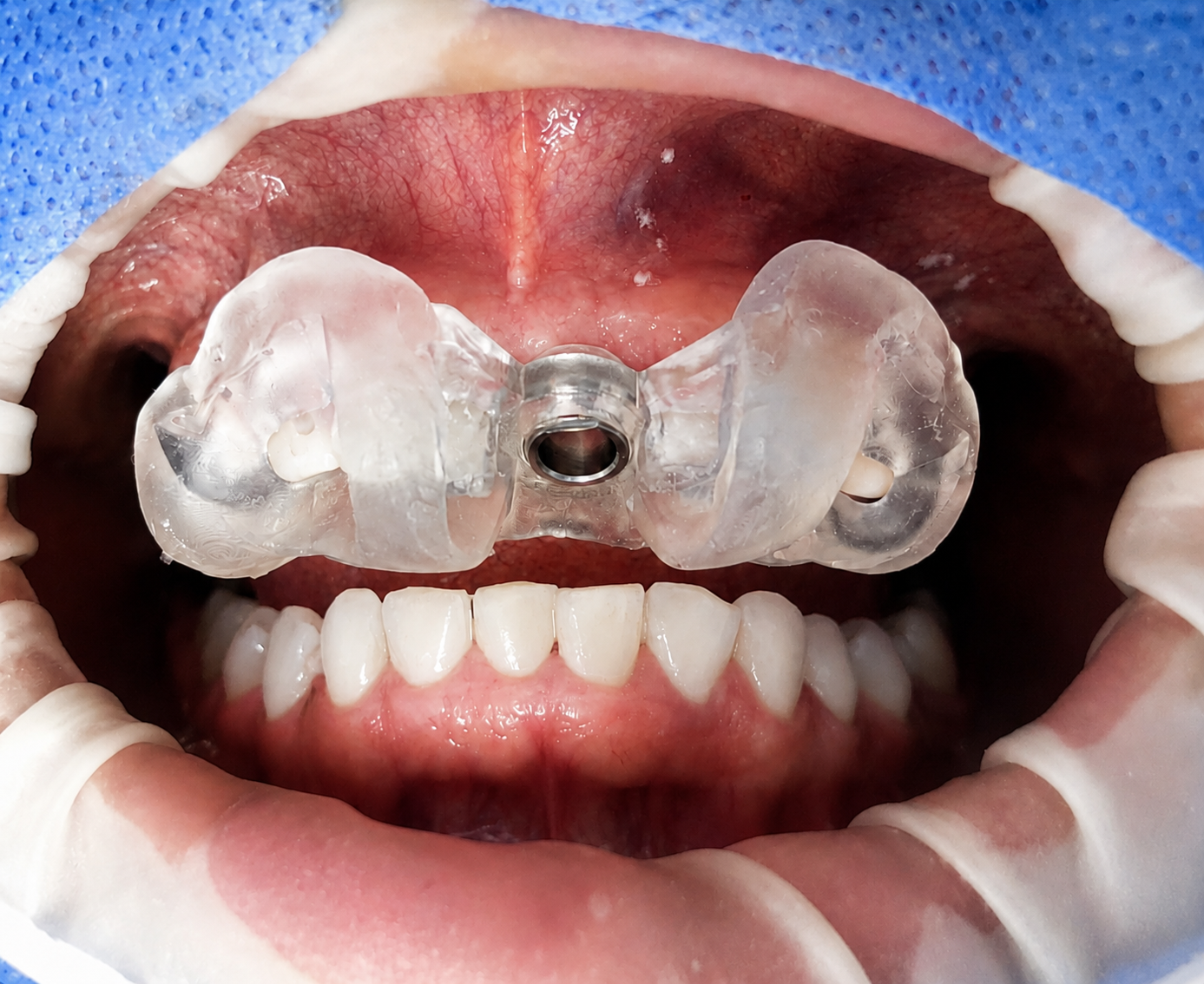 Procedimiento Guiado Implantes