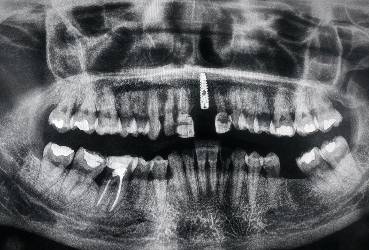 Planificación Virtual Implantes