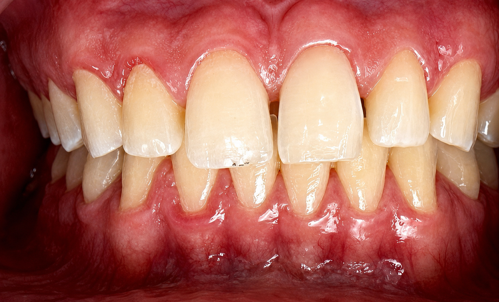 Antes del microdiseño de sonrisa