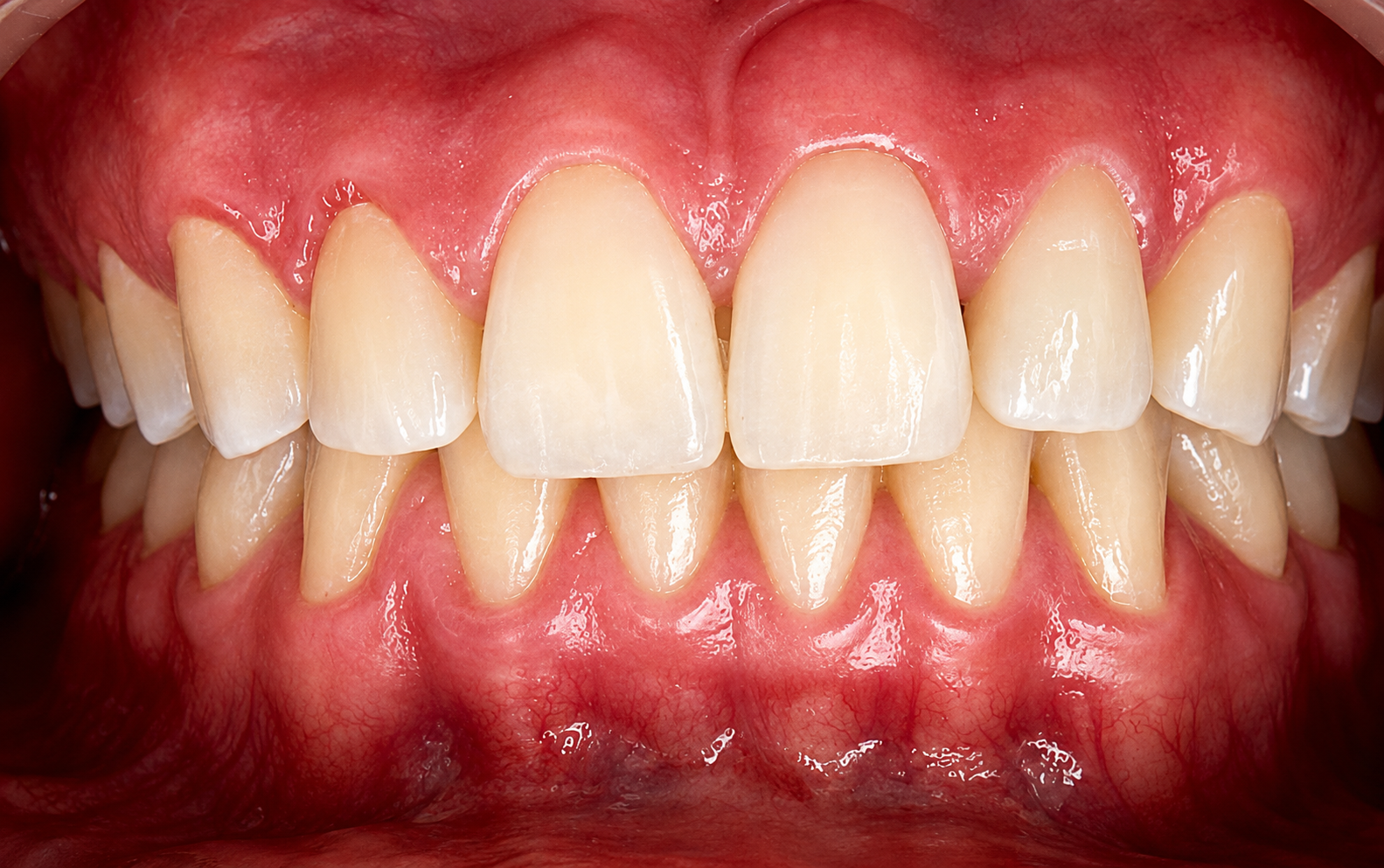 Después del microdiseño de sonrisa