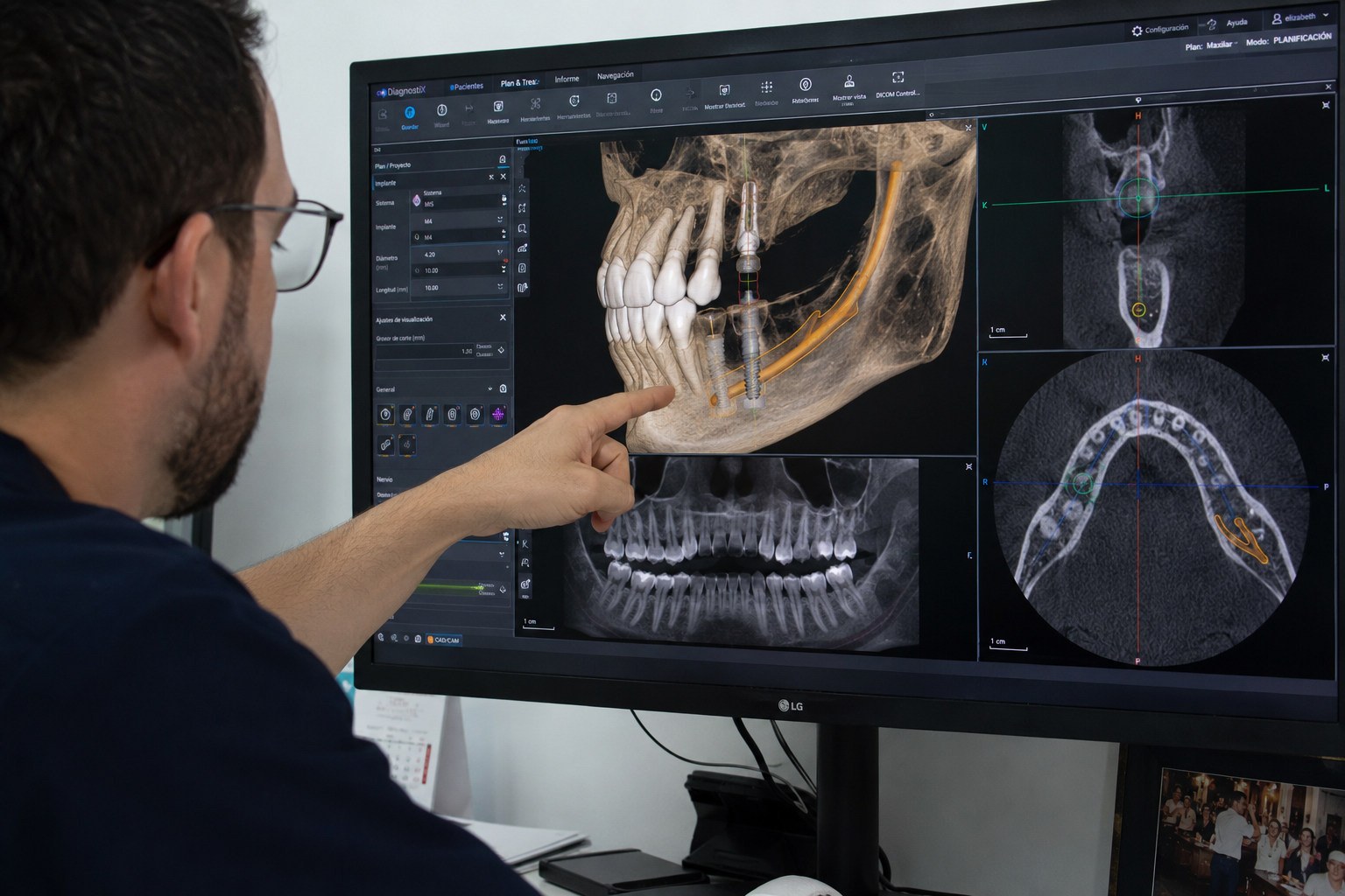 Planificación Virtual Implantes