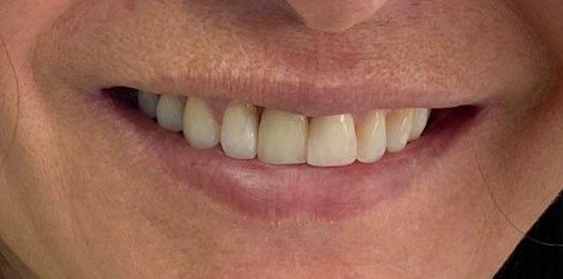 Colocación de implante dental guiado